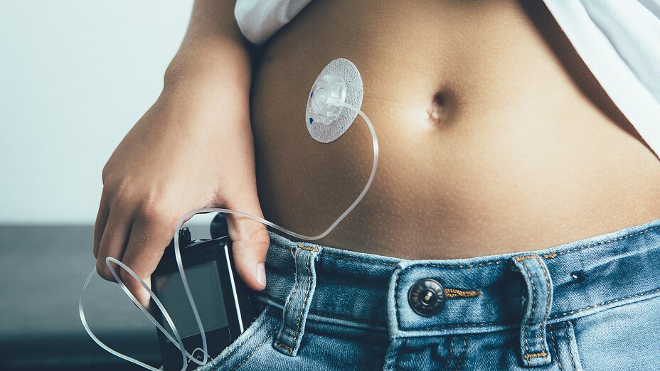 Diabetic patient with insulin pump and skin-worn sensor Diabetic patient with an insulin pump dressing connected in his abdomen and insulin pump in pocket